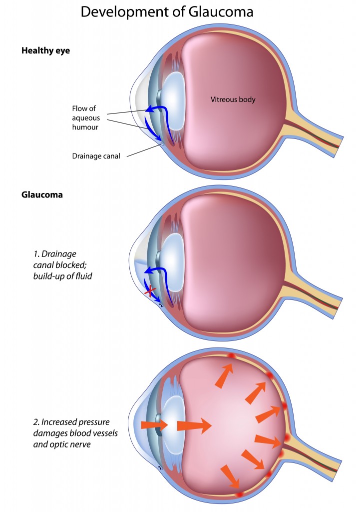 glaucoma