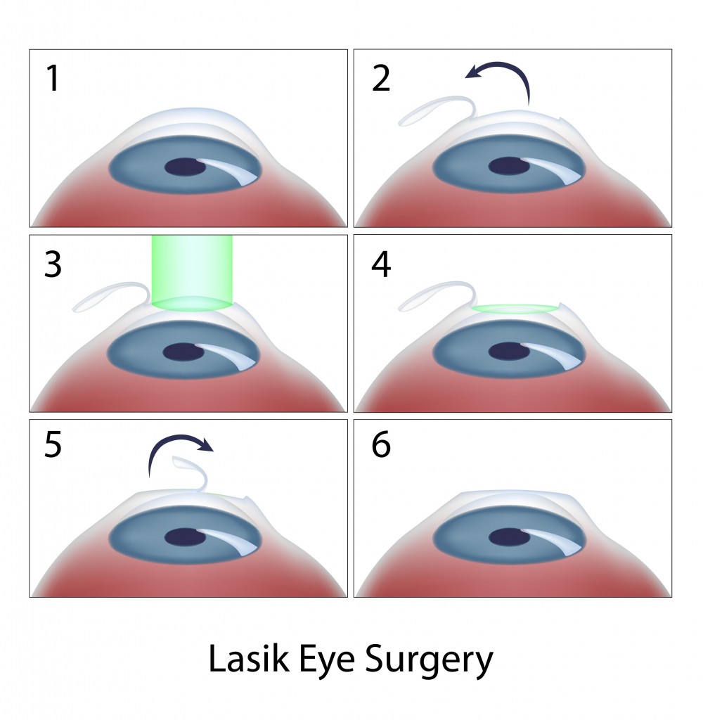 LASIK Graphic