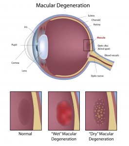 Macular Degeneration Progression