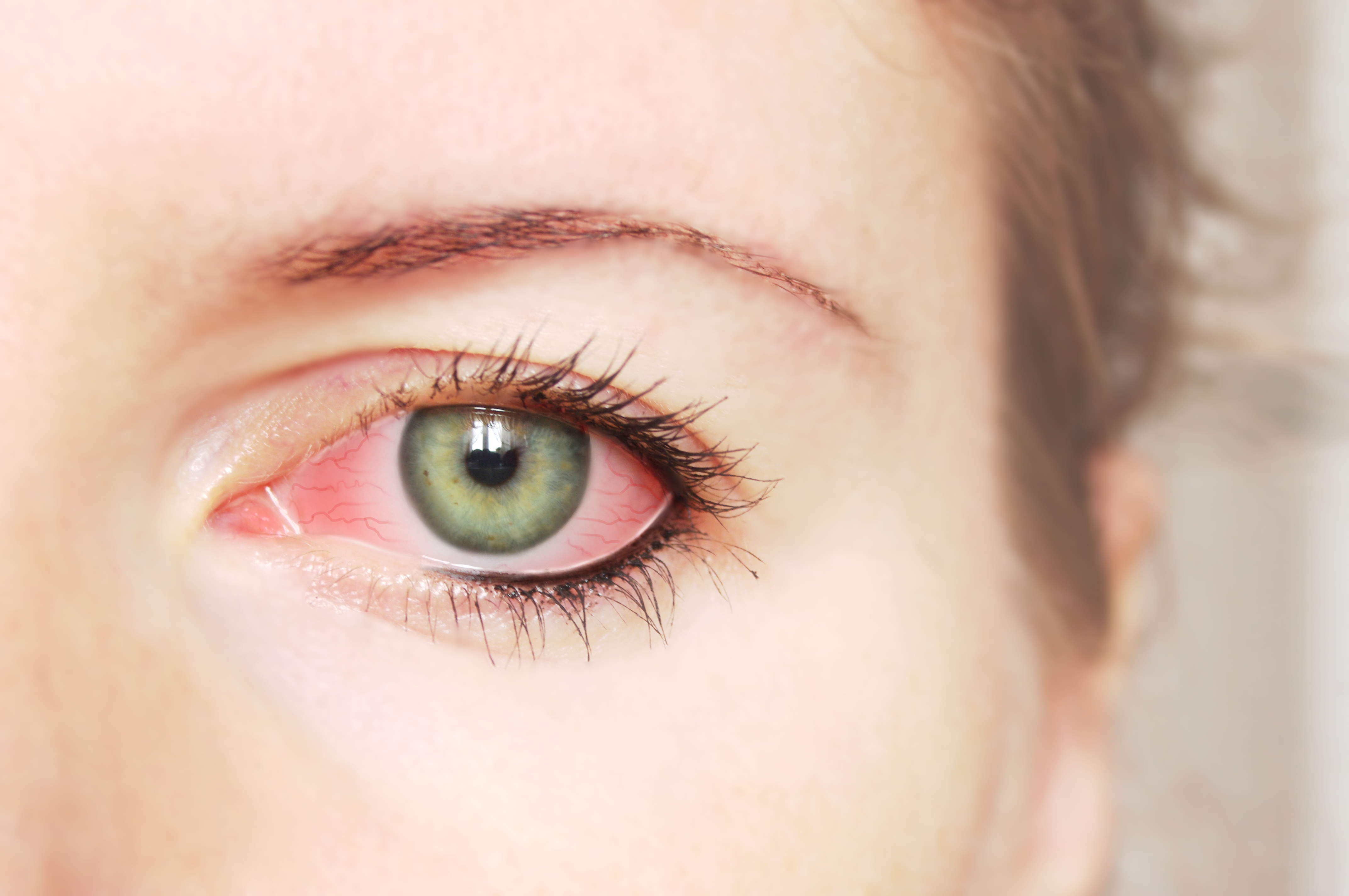 Pink Eye Causes And Treatment