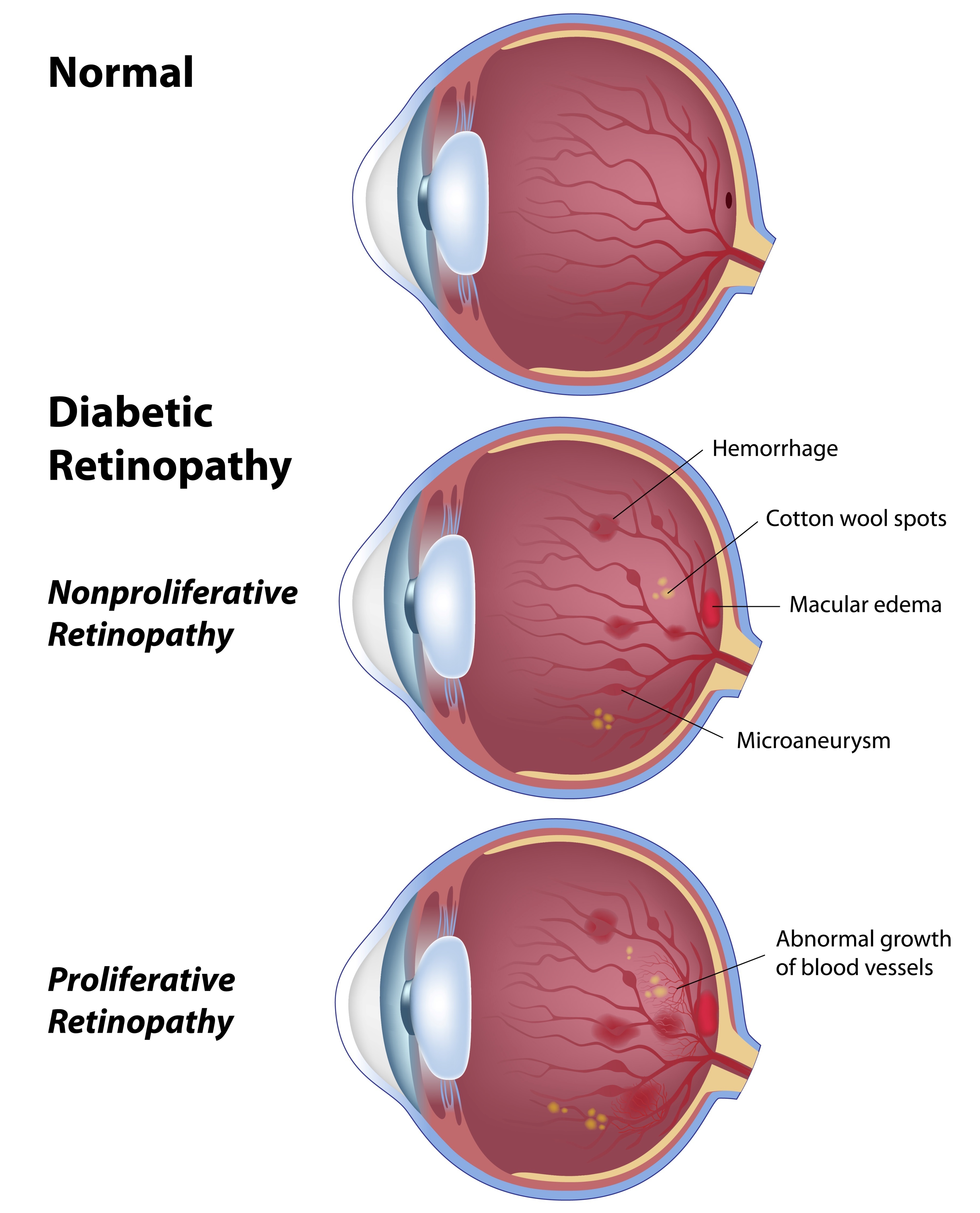 thesis on diabetic retinopathy