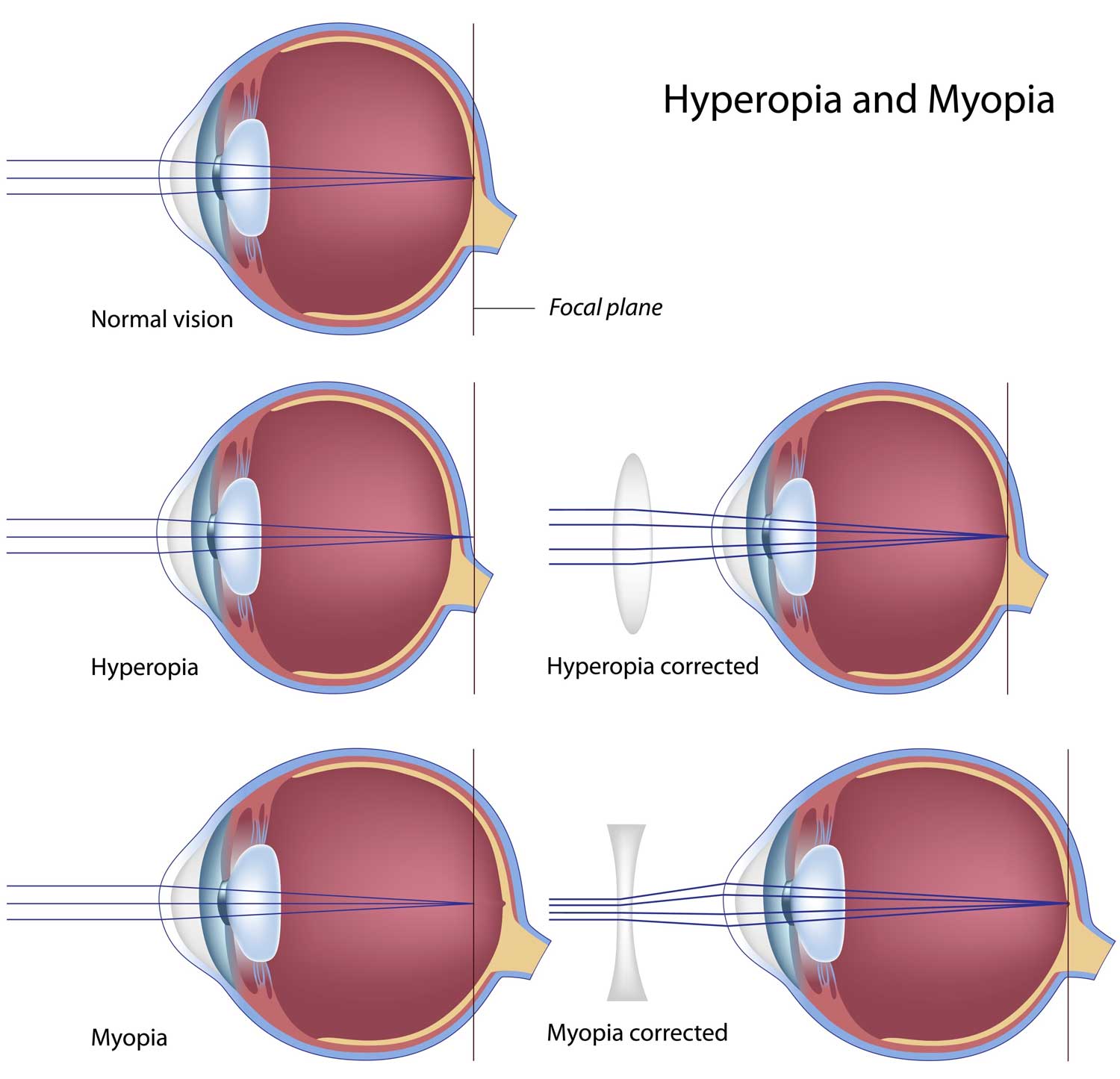A myopia idős korban alakul ki