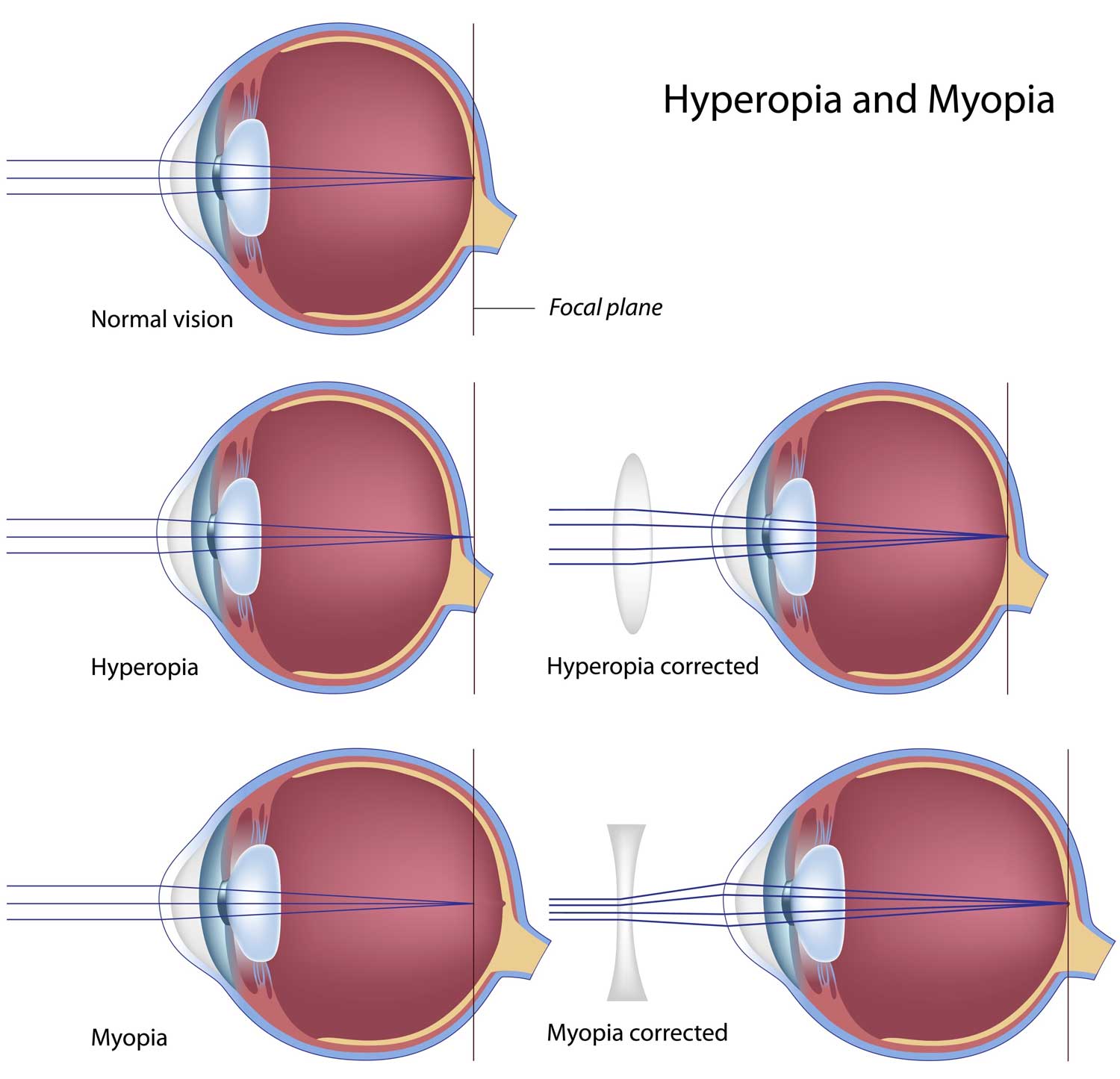 What Hyperopia Looks Like