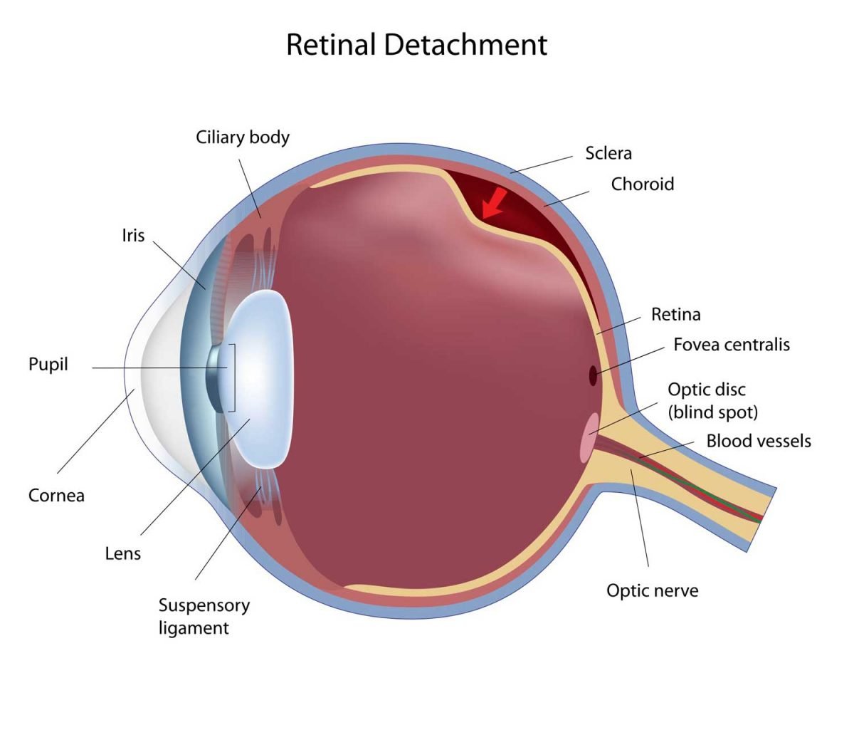 Vitreous Eye Floaters & Retinal Detachment Petrou Eye Care